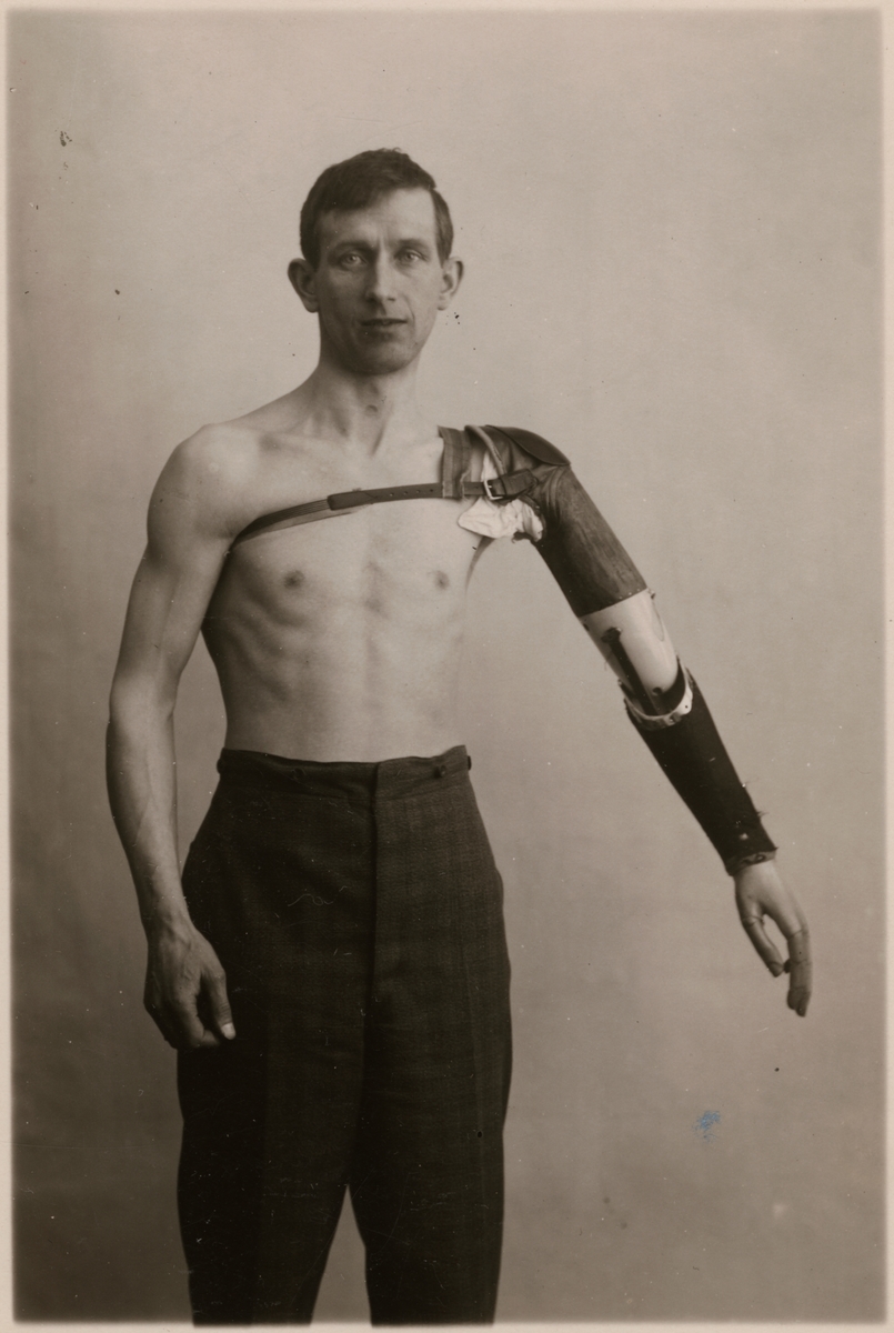 Fotografi från "Redogörelse för tillverkning vid Statens Järnvägars protesverkstad i Nässjö", 1932.
Man med armprotes.