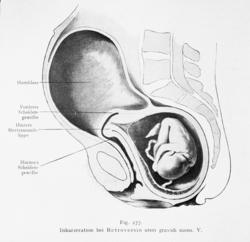Avfotografert tegning av foster som er "fengslet" i en bakov