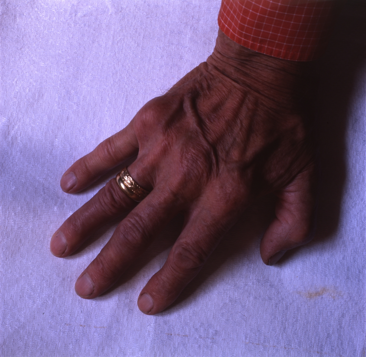 Hildings högra hand med ringar juli 1997.